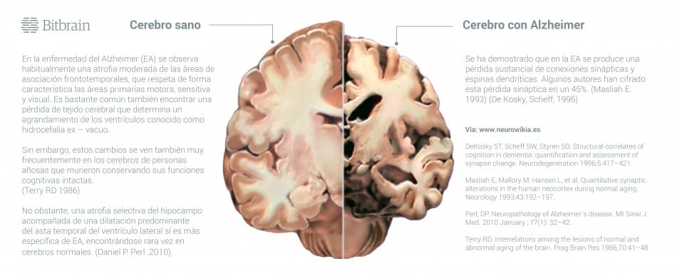 Cerebro Demencia Deterioro Cognitivo 2