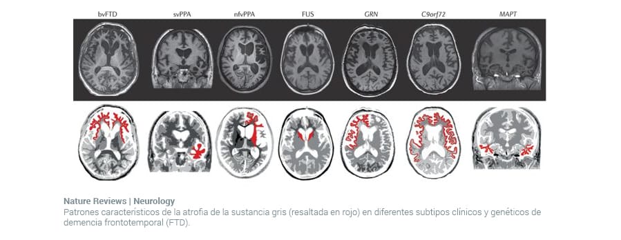 Cerebro Demencia Deterioro Cognitivo 0