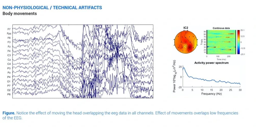 Eeg Artifact Body Movements