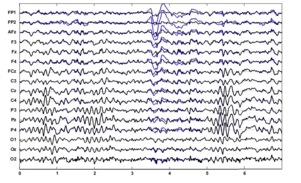 Eeg Artifacts