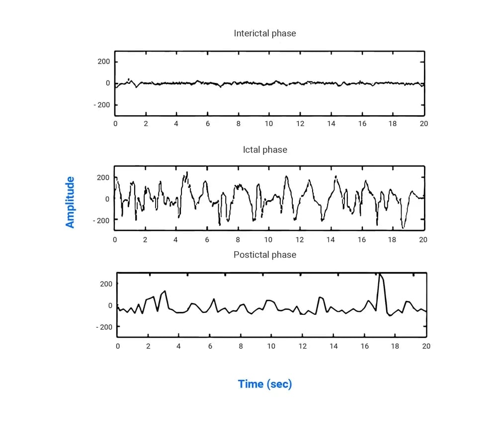 Eeg Signal Seizures 0