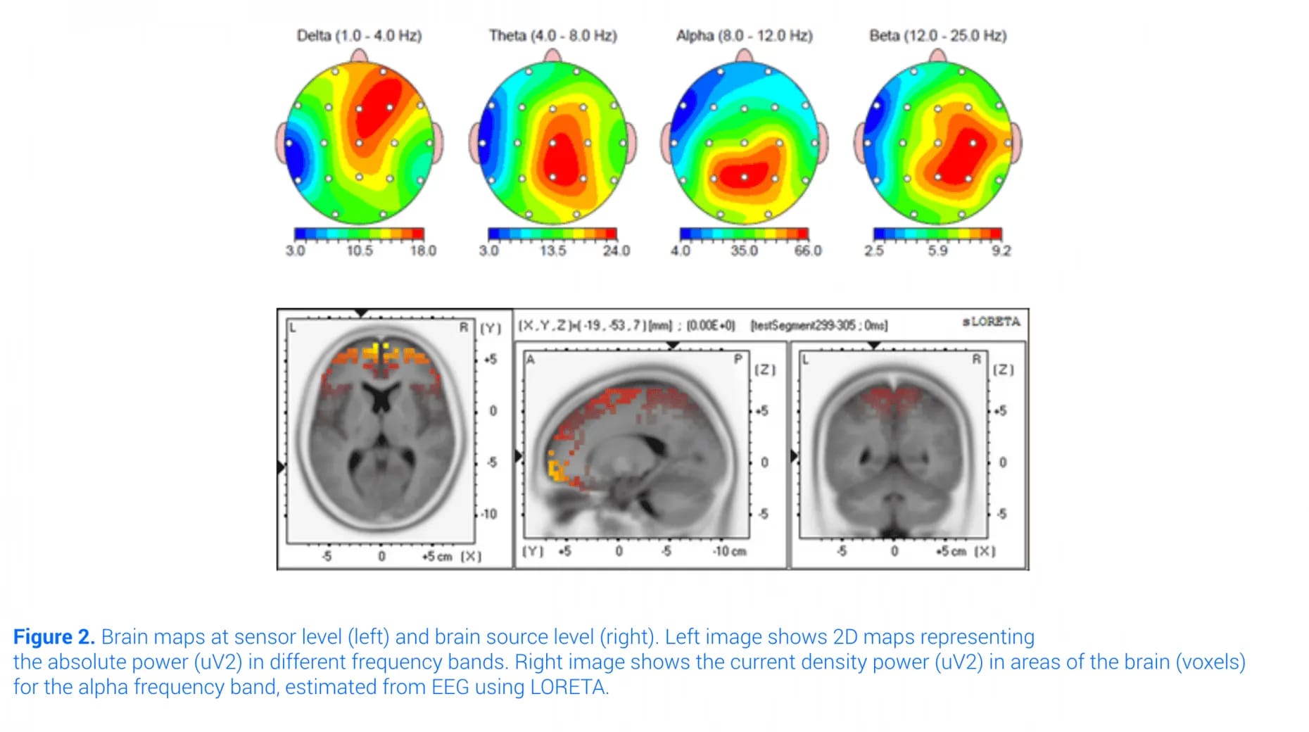 Loreta Qeeg Graphs 0 Optimized