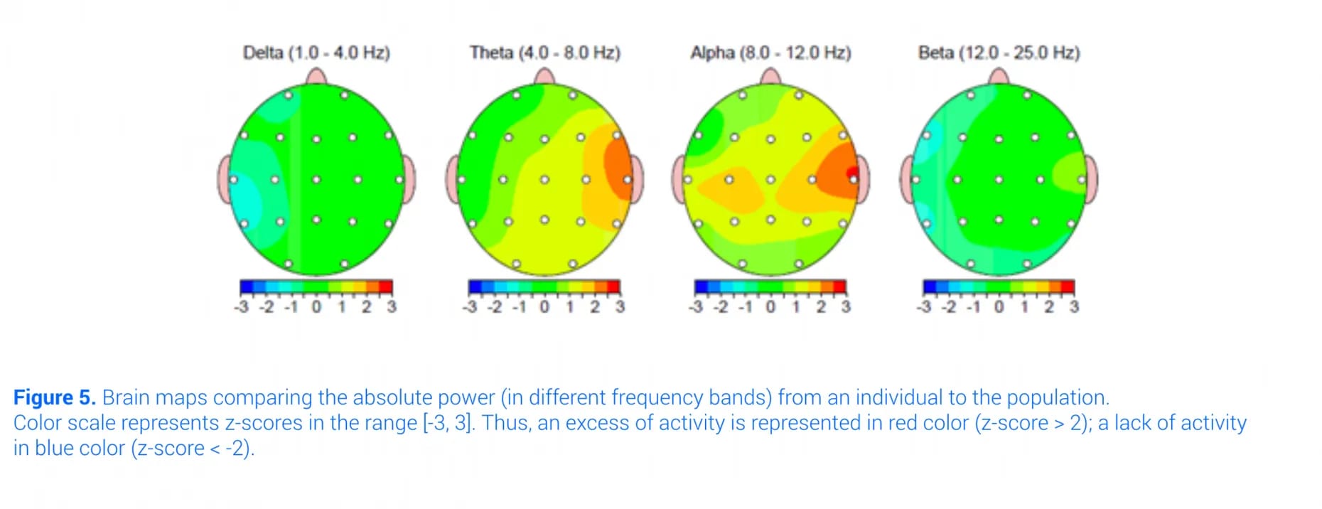 Qeeg Dimensional Brain Maps